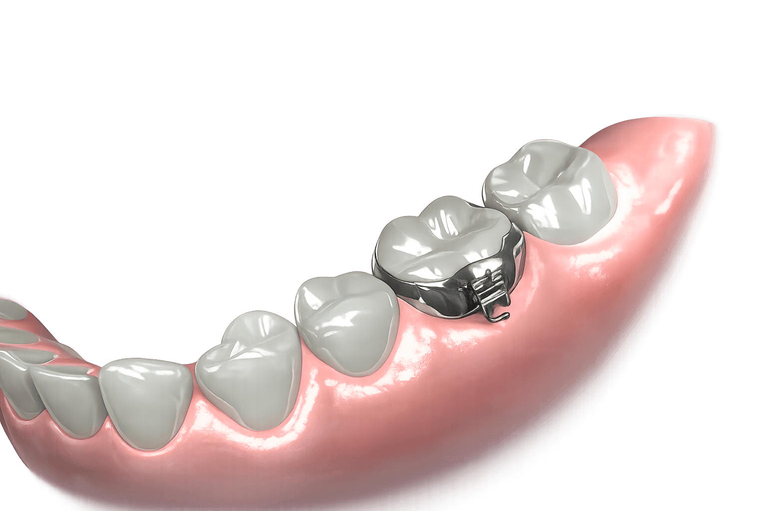MOLAR BAND `